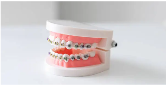 dental braces Adelaide